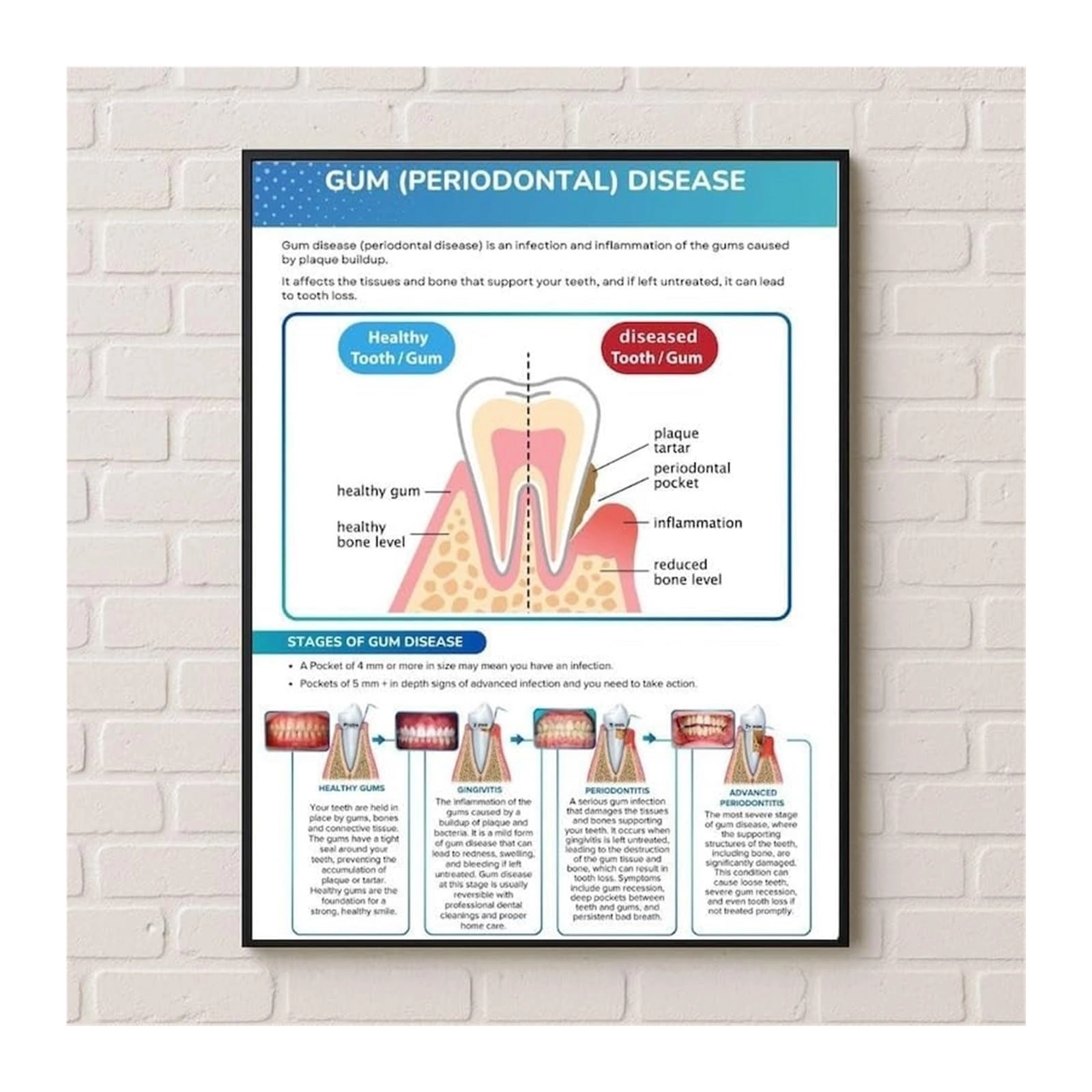 zdvhomcb Oral Hygiene Educational Poster - Canvas 16x24inch(40x60cm)